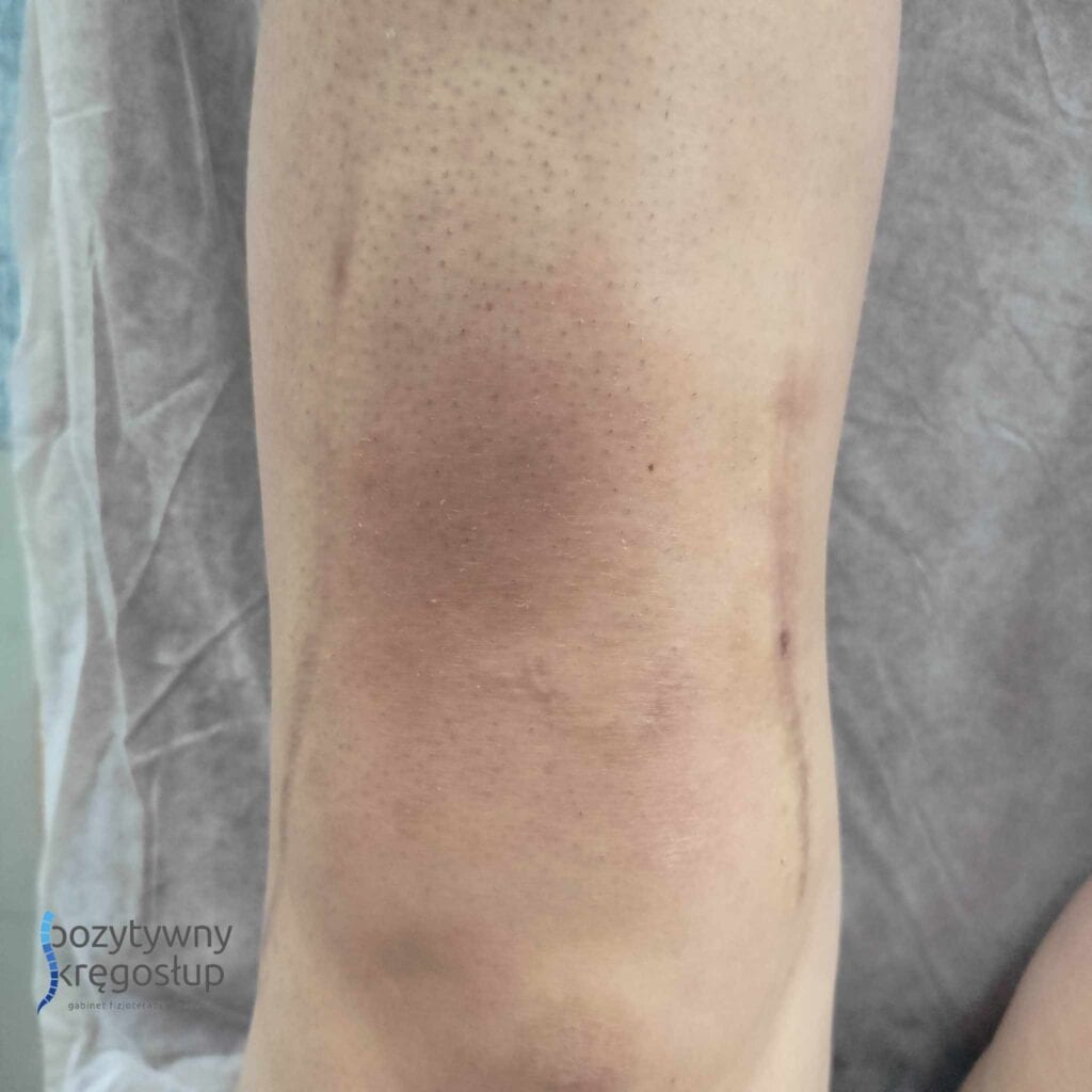 terapia-blizny-zdjecie-1